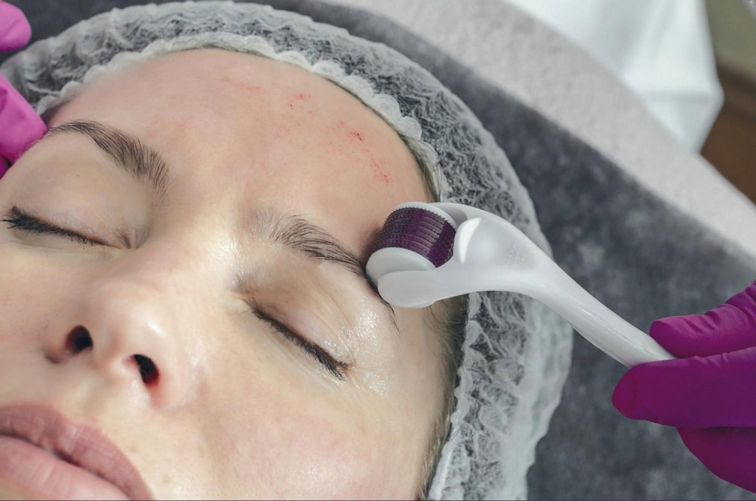 Chemical Peels vs. Microneedling vs. Laser Resurfacing: Which One Is Right for You?